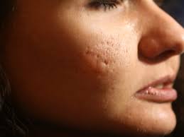 remove acne scars