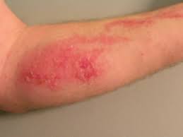 Poison Ivy rash - xplina.com