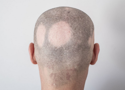 Hair loss due to alopecia