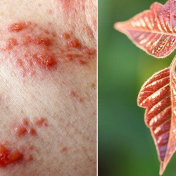 Poison Ivy Rash: New Findings on Prevention & Treatment