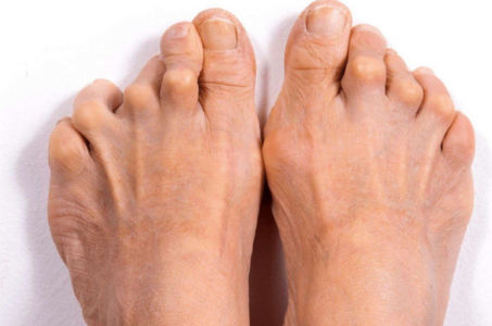 rheumatoid arthritis feet