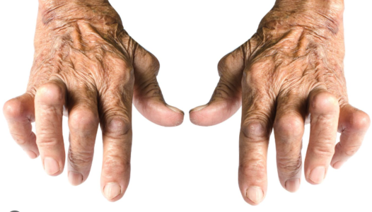 arthritis of the hands